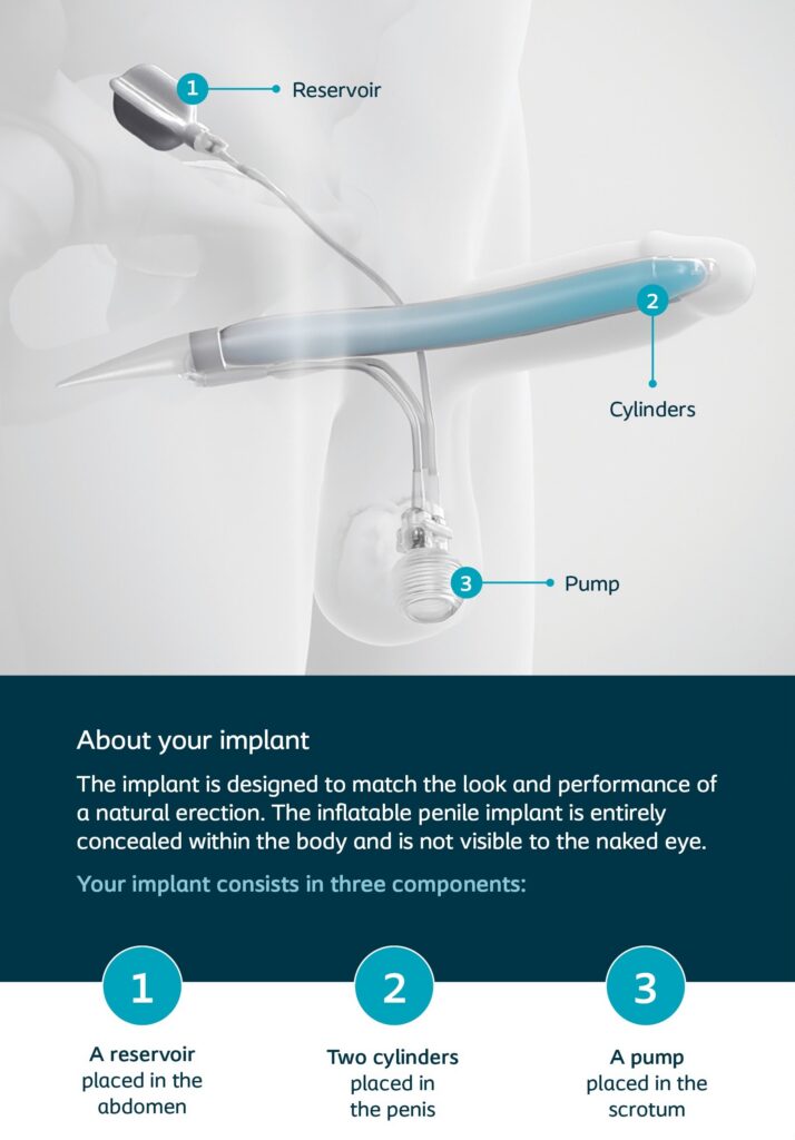 about-titan-implant_penile-implants_cpmh about titan implant